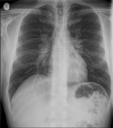 Sarcoidosis - stage I | Image | Radiopaedia.org