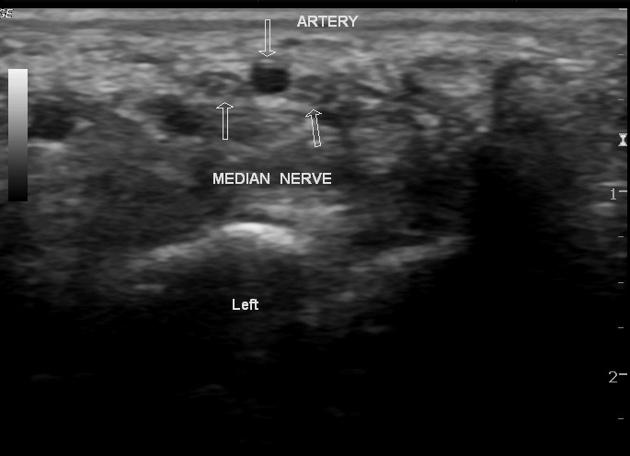 Bifid median nerve, Radiology Reference Article