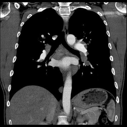 Sarcoidosis (thoracic manifestations) | Radiology Reference Article ...