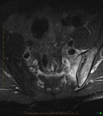 Unilateral sacroiliitis | Radiology Case | Radiopaedia.org