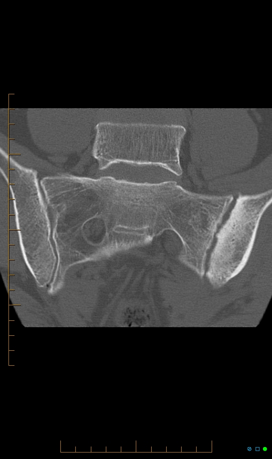 Unilateral Sacroiliitis Image Radiopaedia Org