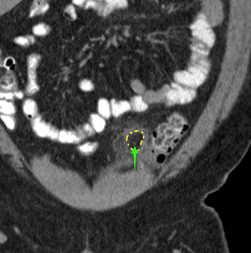 Featured image of post Epiploic Appendagitis Radiopaedia Epiploic appendages are small lobulated adipous tisue protruding from the serosal surface of the colon