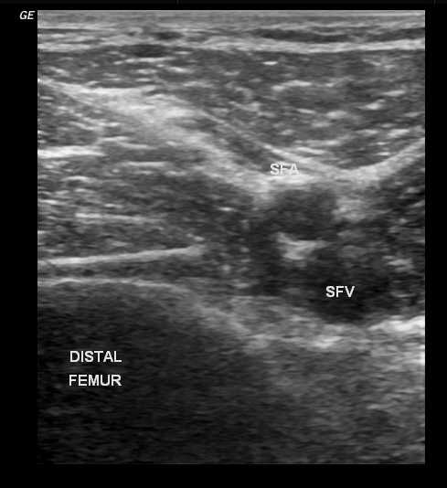 Foreign body in thigh | Image | Radiopaedia.org