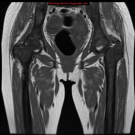 Avascular necrosis in sickle cell disease | Image | Radiopaedia.org