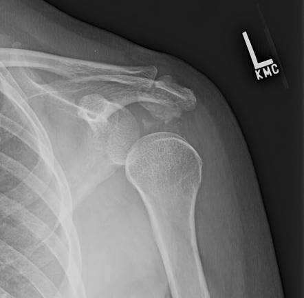 Calcific bursitis | Image | Radiopaedia.org