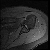 Tag: calcific bursitis | Radiopaedia.org