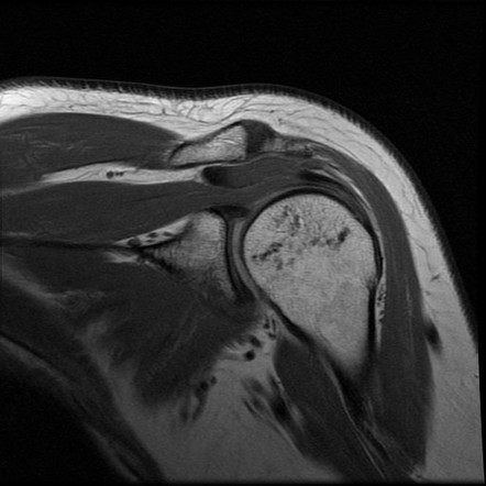 Calcific bursitis | Image | Radiopaedia.org