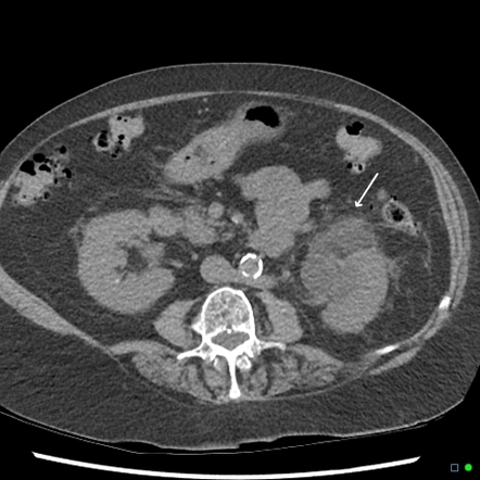 Spontaneous rupture renal pelvis seconday to bladder tumor | Image ...