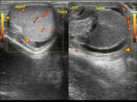 Testicular Torsion Radiology Case Radiopaedia Org