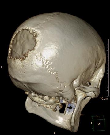 Skull metastasis | Radiology Case | Radiopaedia.org