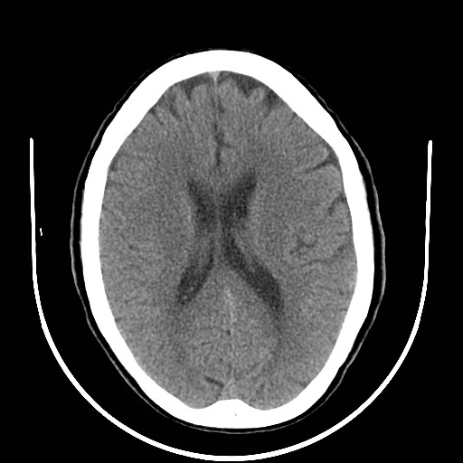 Developmental venous anomaly (DVA) | Image | Radiopaedia.org