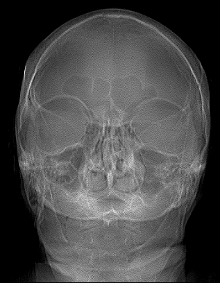 Bilateral thinning of the parietal bones | Image | Radiopaedia.org