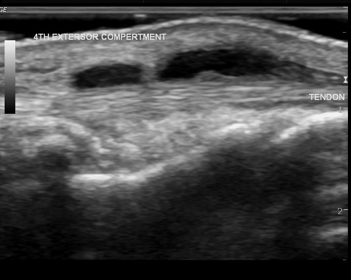 Foreign body induced tenosynovitis in wrist | Image | Radiopaedia.org