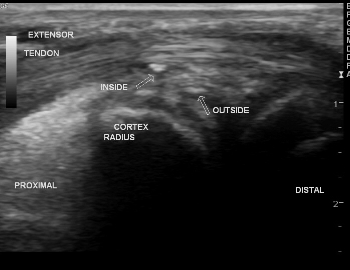 Foreign body induced tenosynovitis in wrist | Image | Radiopaedia.org