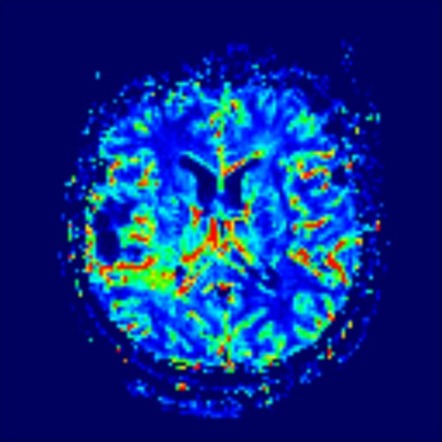 Glioblastoma, IDH- wildtype (pseudoprogression) | Image | Radiopaedia.org