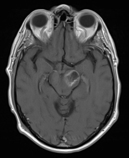 Oligoastrocytoma NOS with pseudoprogression | Image | Radiopaedia.org