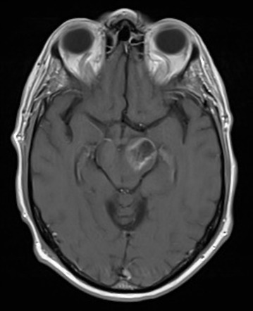 Oligoastrocytoma Nos With Pseudoprogression 