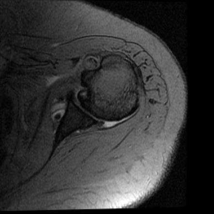 Supraspinatus and long biceps tendinosis | Radiology Case | Radiopaedia.org