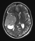 intracranial non neoplastic cysts radiology reference article radiopaedia org