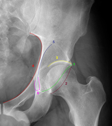 Ilium, Radiology Reference Article