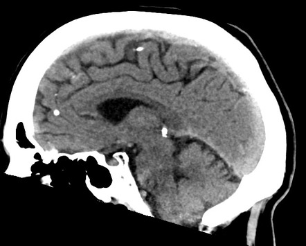 Glioblastoma NOS (subtle abnormality on CT) | Image | Radiopaedia.org