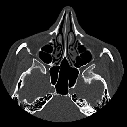 Sinuses On Ct Scan