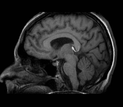 Pericallosal ribbon lipoma | Image | Radiopaedia.org