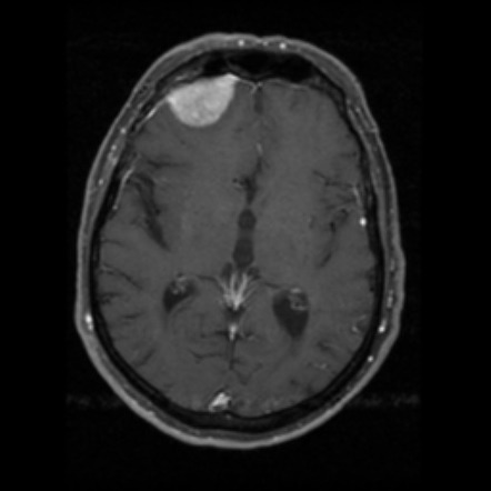 Angiomatous meningioma | Radiology Reference Article | Radiopaedia.org