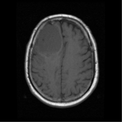 Angiomatous meningioma | Image | Radiopaedia.org