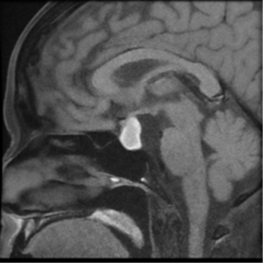 Rathke's cleft cyst | Image | Radiopaedia.org