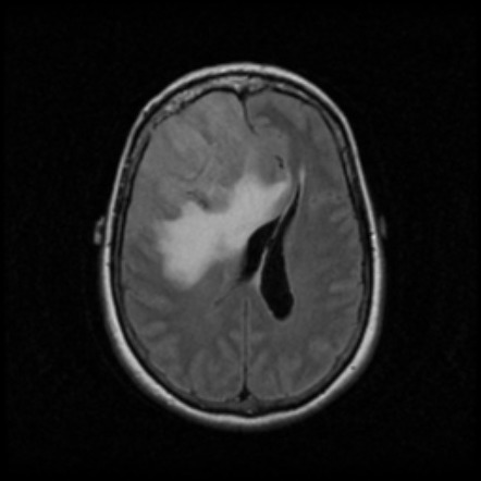 Meningothelial meningioma | Radiology Reference Article | Radiopaedia.org