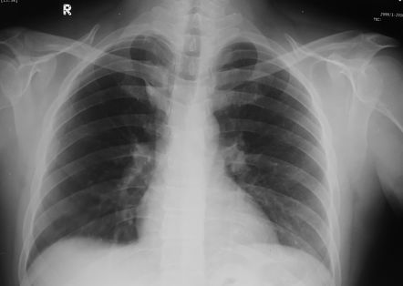 Azygos fissure | Radiology Case | Radiopaedia.org