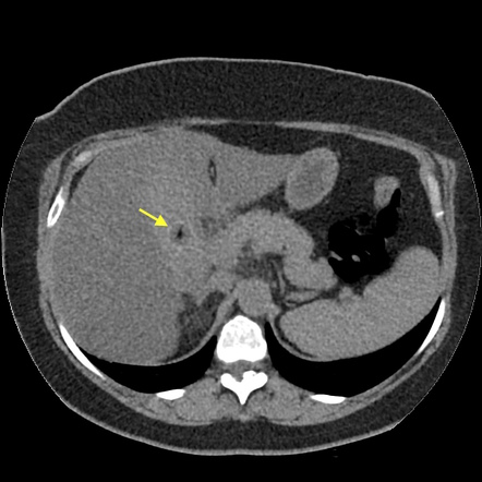 Acute cholecystitis and ureteric colic | Image | Radiopaedia.org