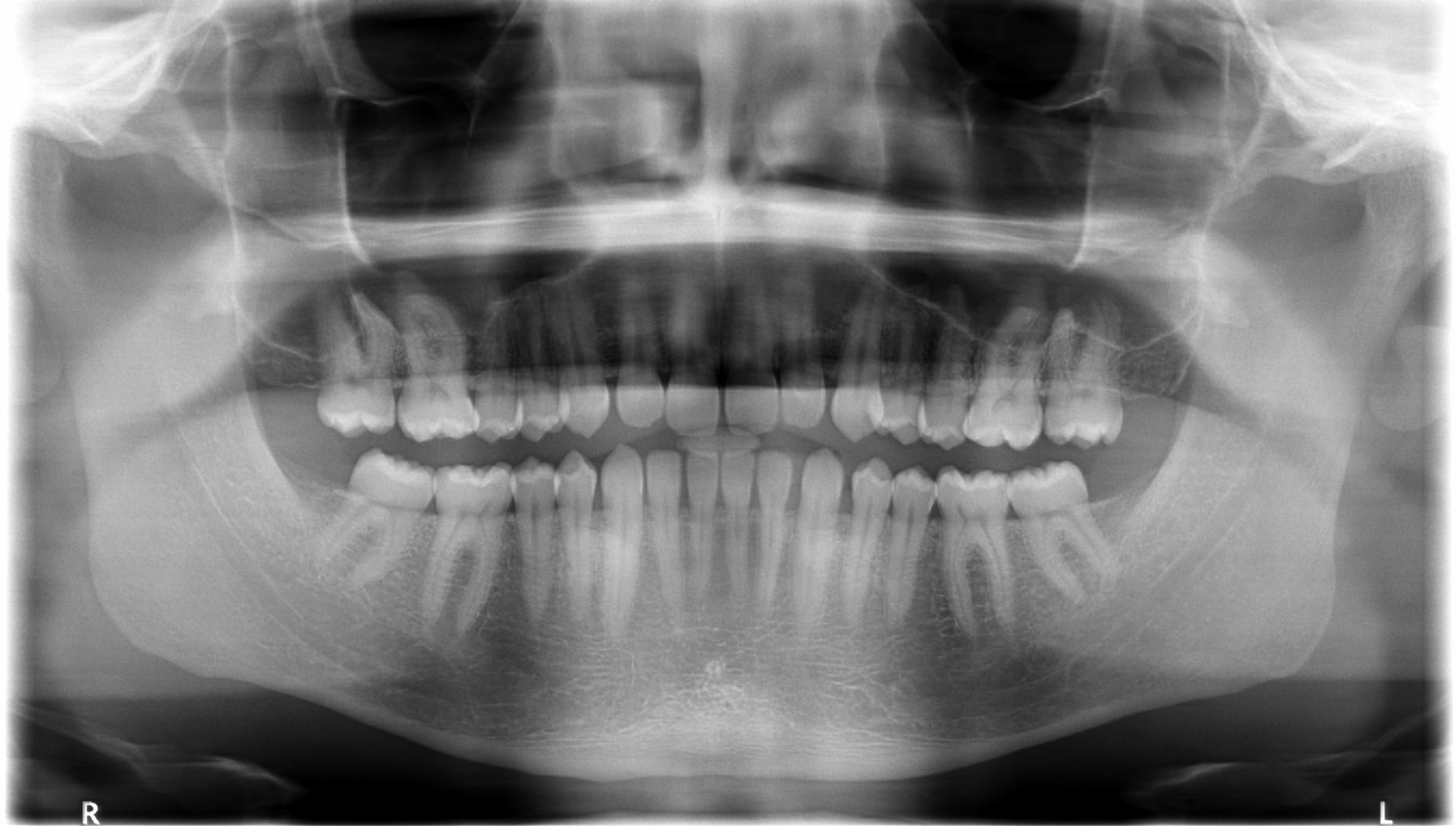 Рентген ортопантомограмма зубов