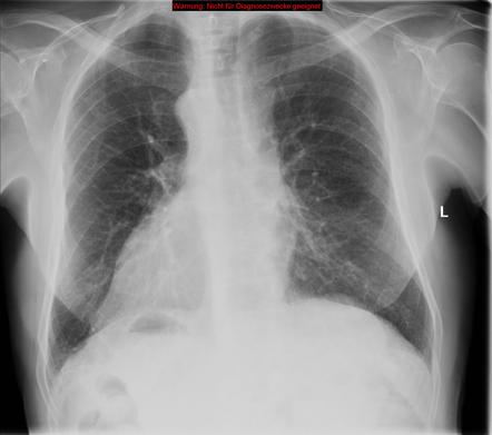 Situs Inversus Totalis