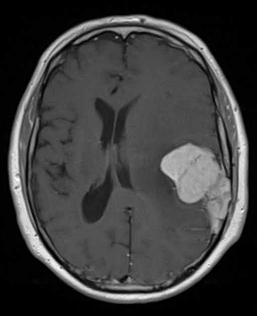 Dural tail sign | Radiology Reference Article | Radiopaedia.org