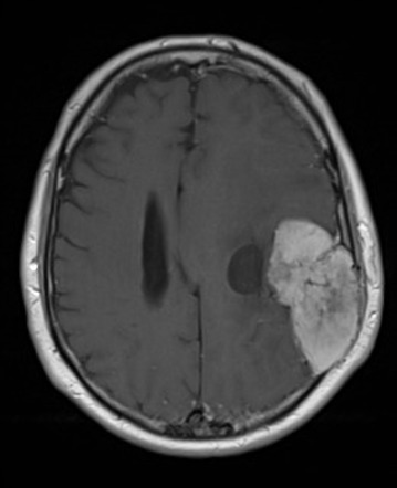 Viewing playlist: CNS tumor | Radiopaedia.org