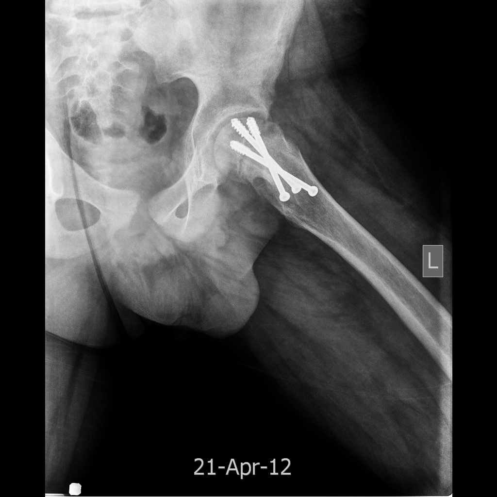 Slipped upper femoral epiphysis with follow up | Image | Radiopaedia.org