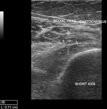 Cysticercosis of gastrocnemius muscle | Image | Radiopaedia.org