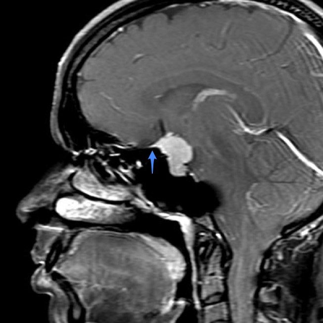 Meningioma Of The Tuberculum Sella Image 0485