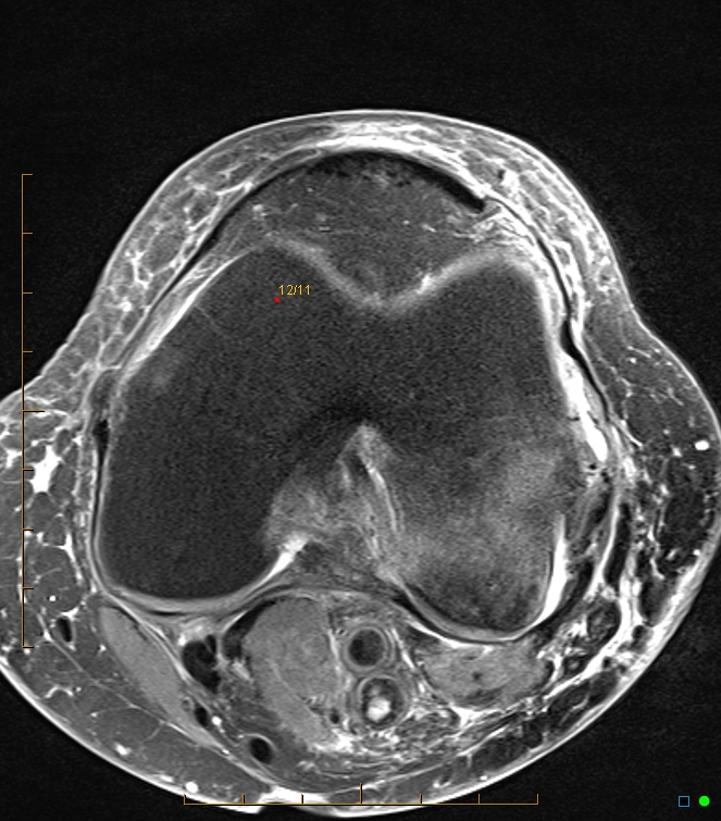 Transient bone marrow edema | Image | Radiopaedia.org