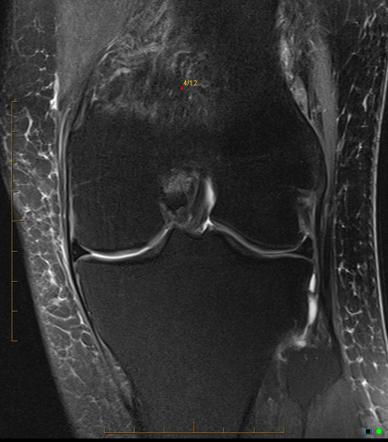 Transient bone marrow edema | Image | Radiopaedia.org