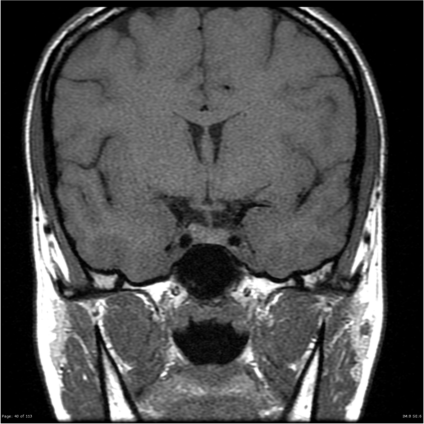 pituitary-mri-normal-study-image-radiopaedia