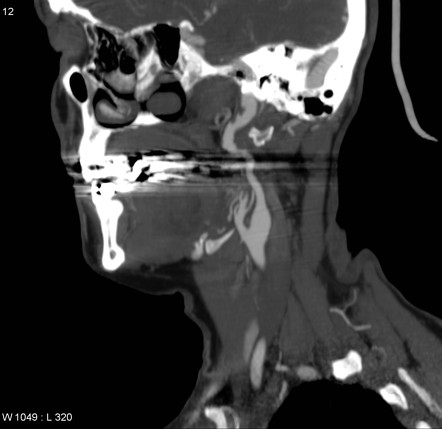 Marfan syndrome - ICA dissection | Radiology Case | Radiopaedia.org