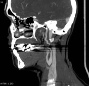 Internal Carotid Artery Dissection Radiology Reference Article Radiopaedia Org