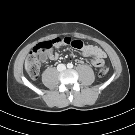 Large dilated appendicitis | Radiology Case | Radiopaedia.org