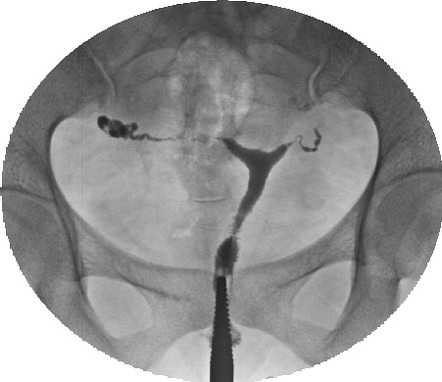 Tuberculosis Fallopian Tube Radiology Reference Article Radiopaedia Org