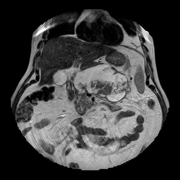 Necrotizing pancreatitis with walled-off necrotic collection | Image ...