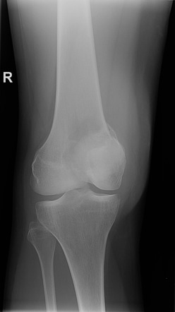 Giant Cell Tumour With Pathological Fracture Of The Distal Femur 