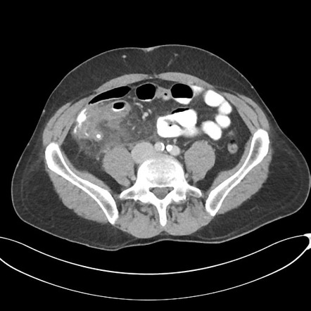 Appendicitis with thickening of the terminal ileum | Radiology Case ...